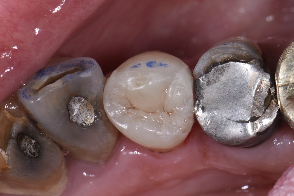 Deep Amalgam staining biomimetic composite