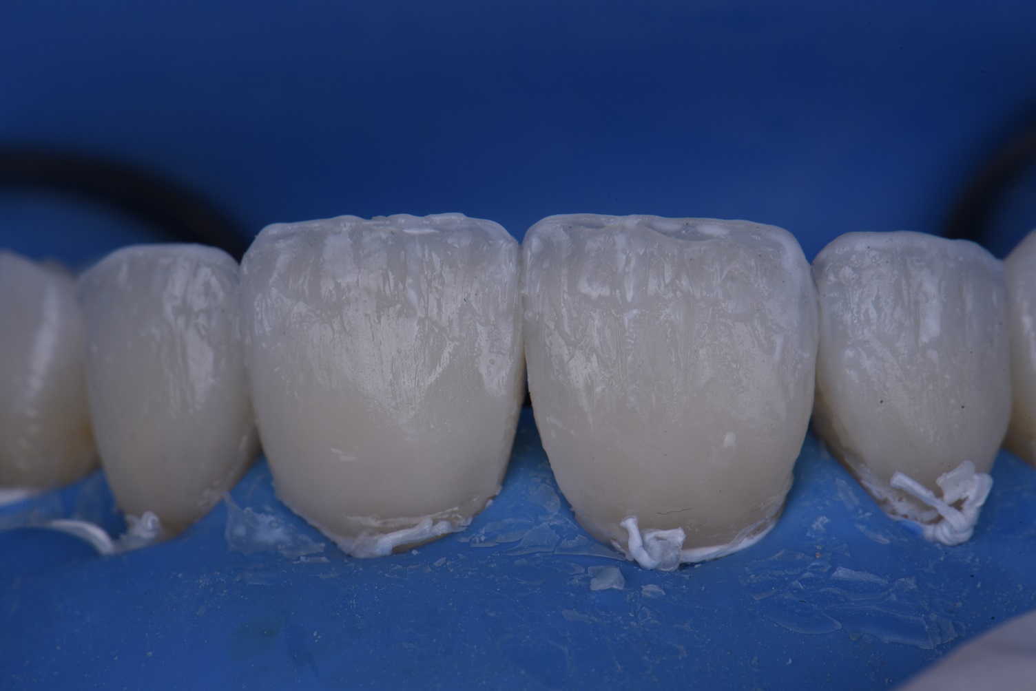 Reproportioning Teeth with Beautifully Layered Composite Veneers