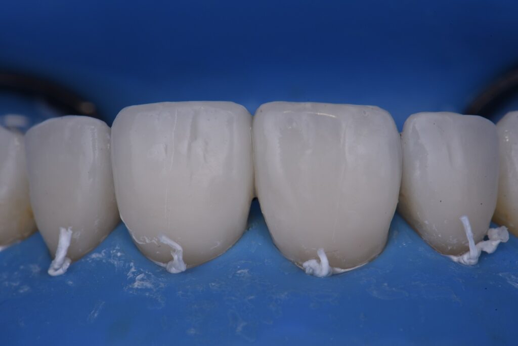 Reproportioning Teeth with Beautifully Layered Composite Veneers