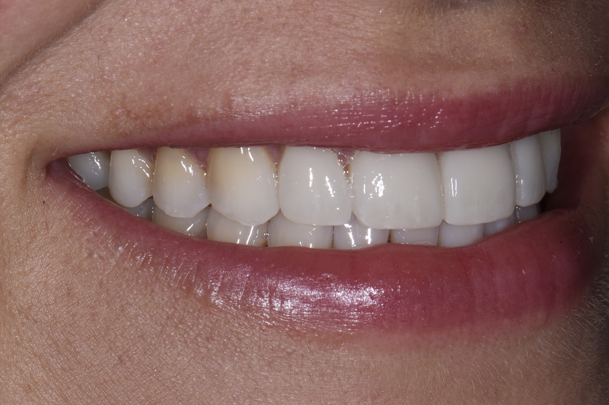 Align Bleach Bond