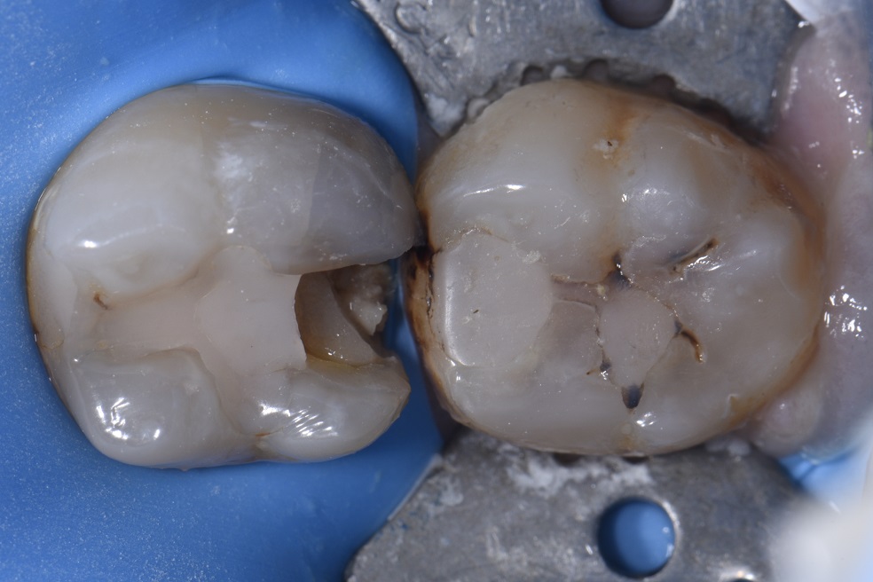Angulated Teeth with Reduced Restorative Space