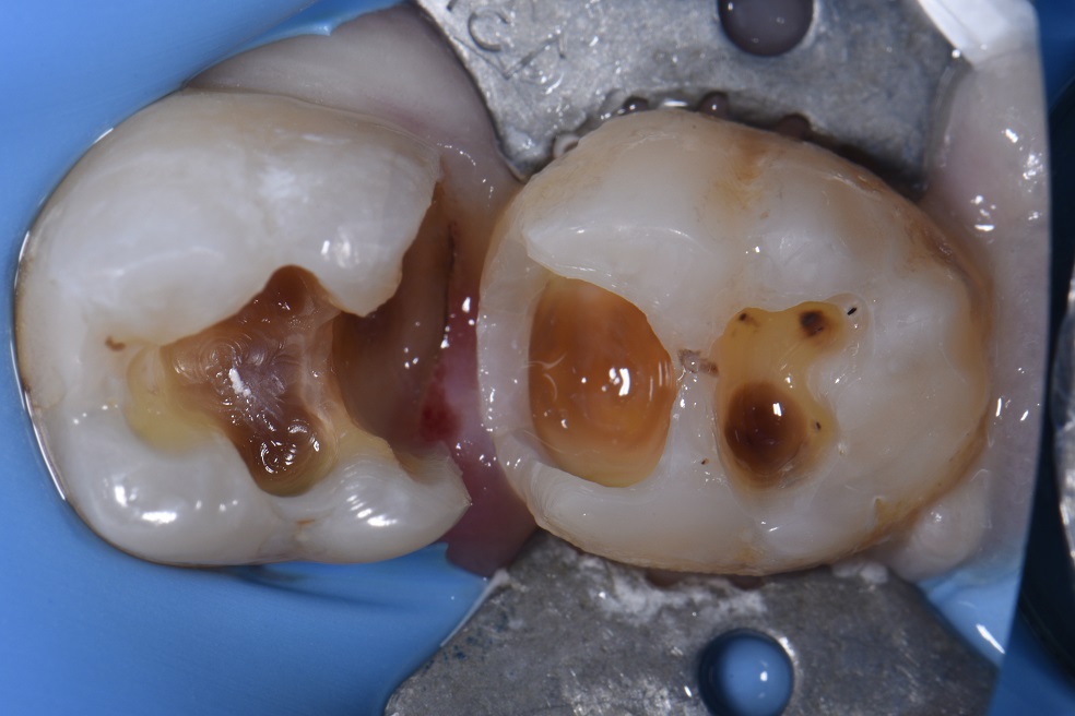 Angulated Teeth with Reduced Restorative Space