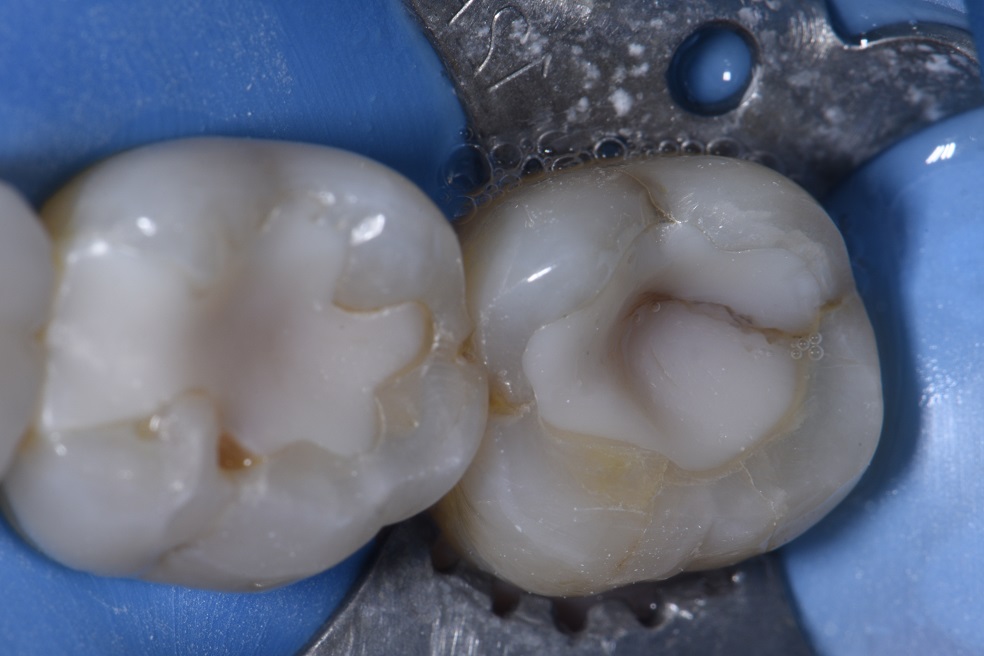 Replacing Leaking Old Composite Fillings