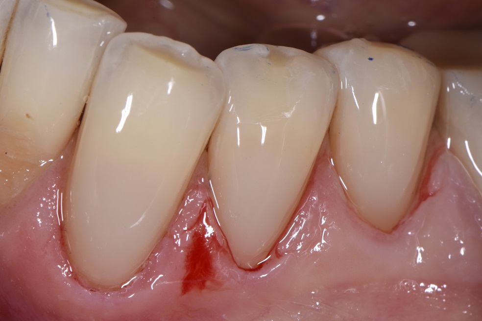 Replacing unesthetic Class V restorations with well blended composite