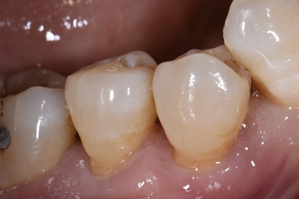 Desensitizing root surfaces using bonded composite