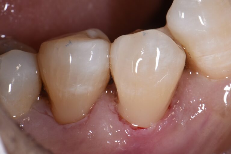 Desensitizing root surfaces using bonded composite