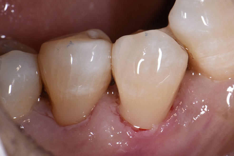 Desensitizing root surfaces using bonded composite