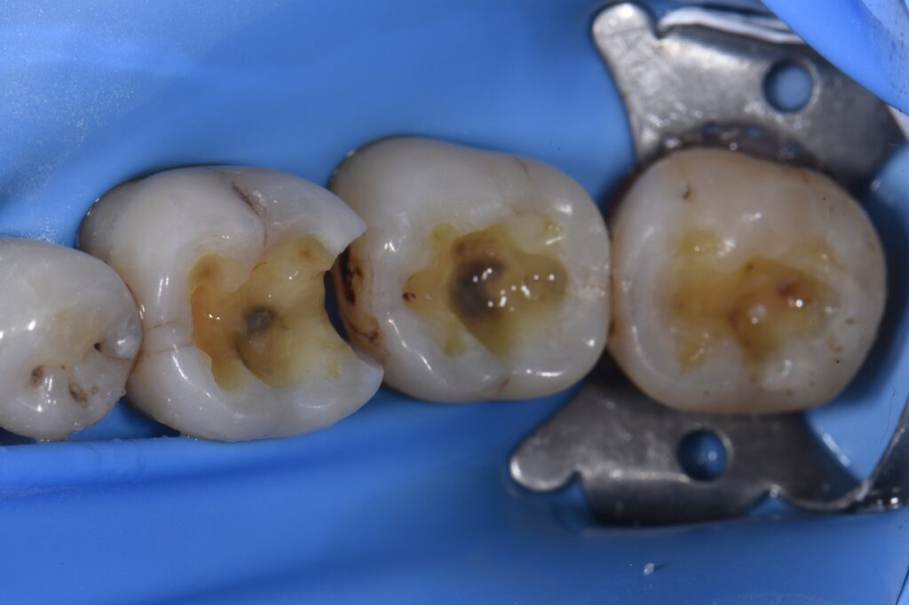 Quadrant biomimetic dentistry