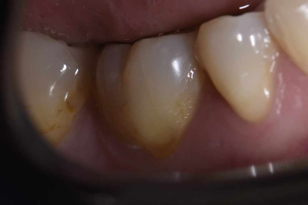 Root protection restorations