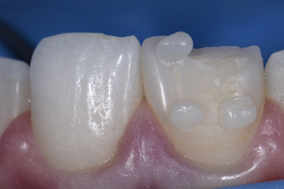 Partial Composite Repairs to Front Teeth