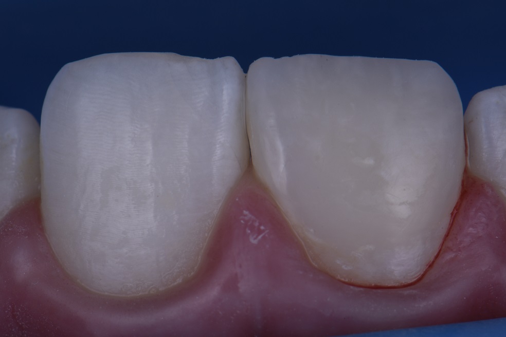 Partial Composite Repairs to Front Teeth