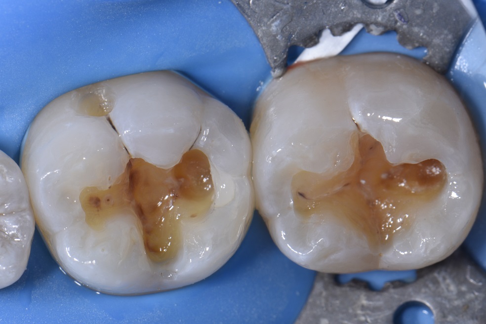 Replacing leaking composite fillings for a young dentist