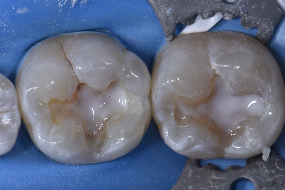 Replacing leaking composite fillings for a young dentist