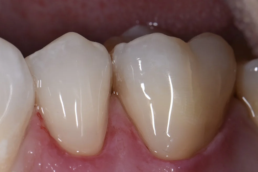 Cervical Abrasion Posterior Composites Buccal