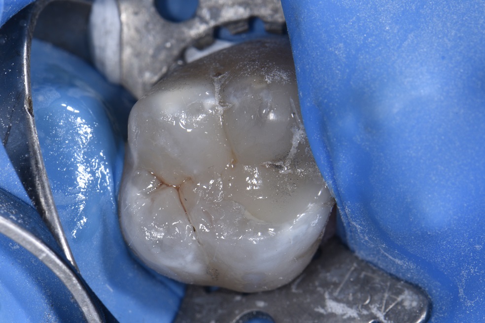 Amalgam Removal