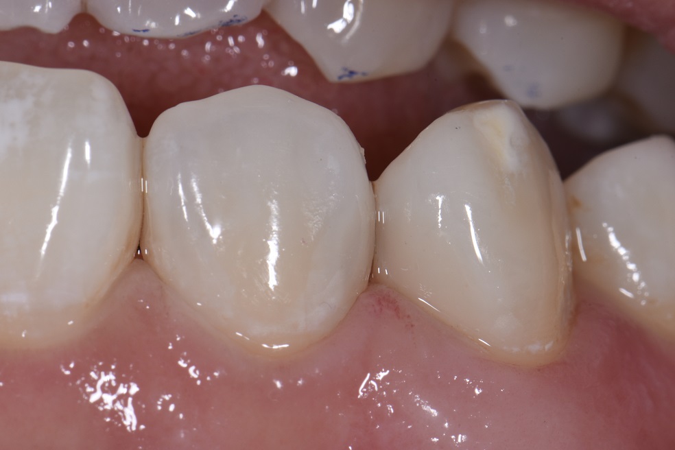 Class III biomimetic restorations