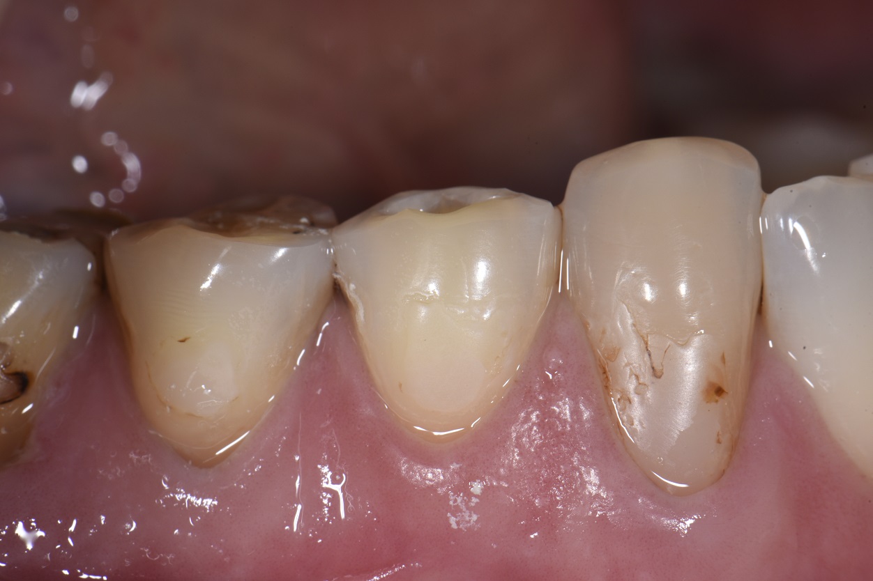 Class V restorations using a hyperfilled resin