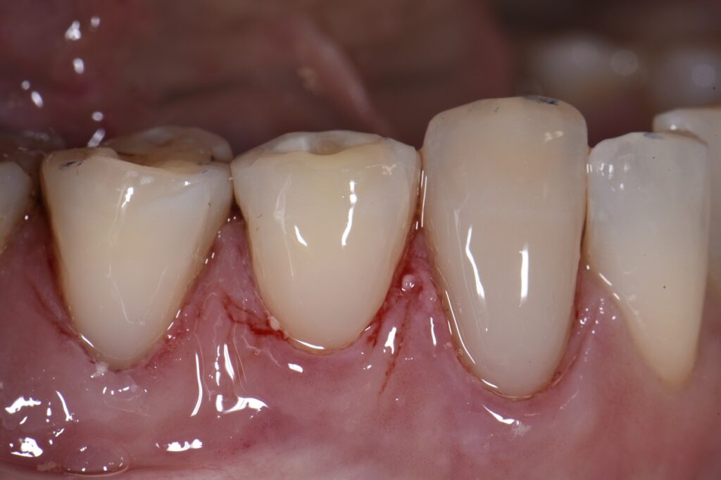 Class V restorations using a hyperfilled resin