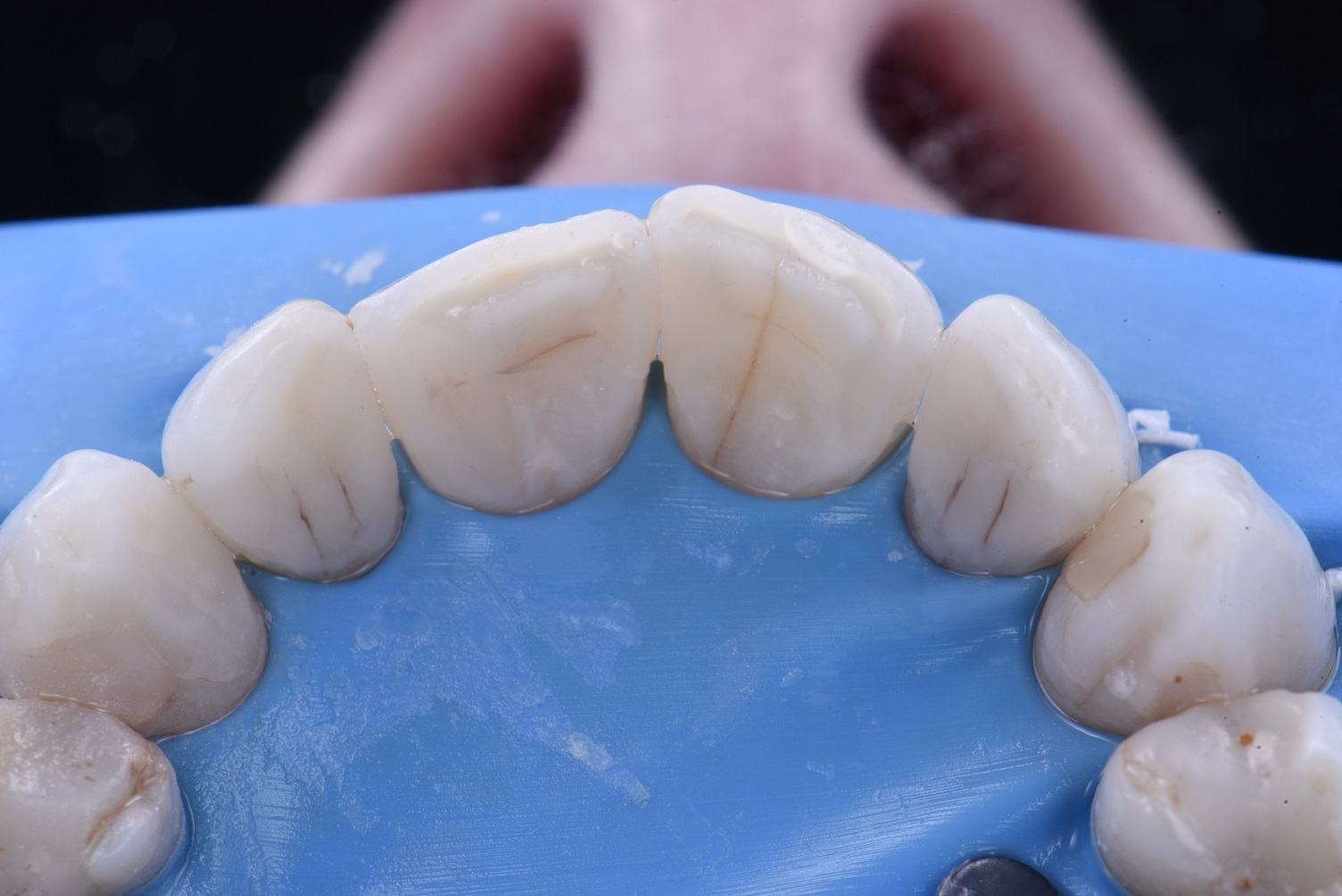Replacing Old Extensive Composite Fillings