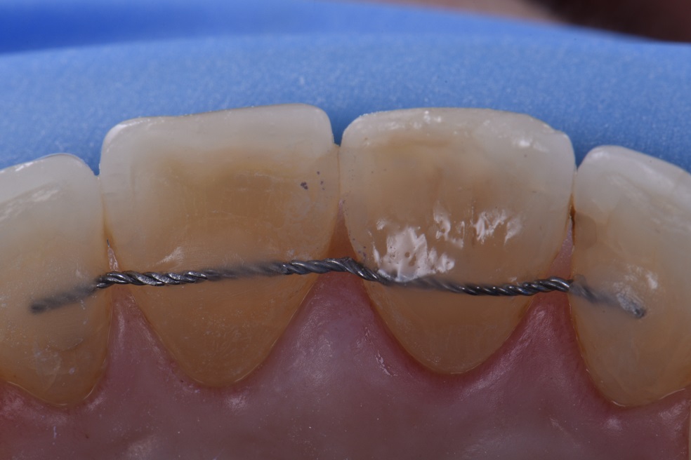 Palatal Concavities Restored