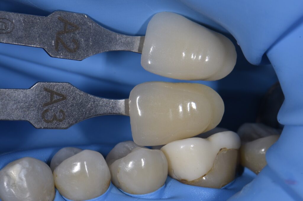 Bonding to Zirconia Cores