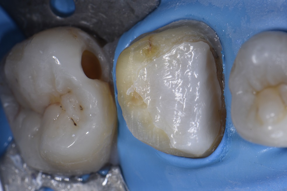 Bonding to Zirconia Cores