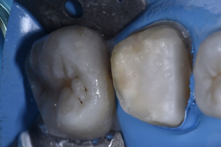 Bonding to Zirconia Cores