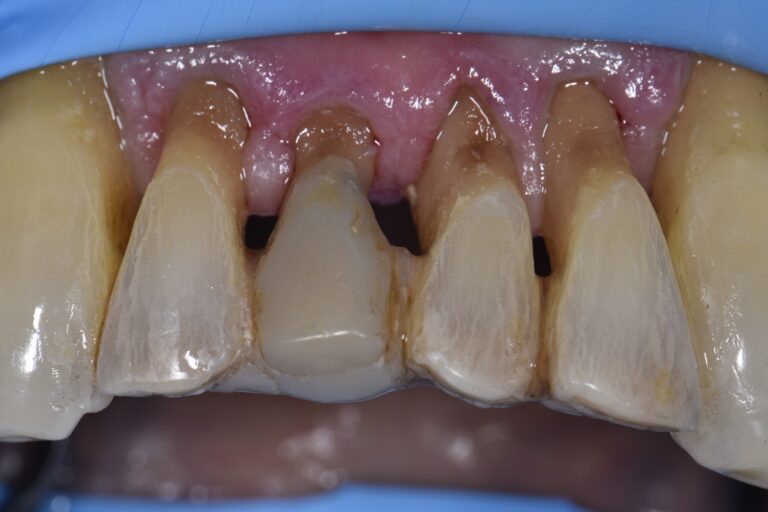 Extreme root abrasion restorations
