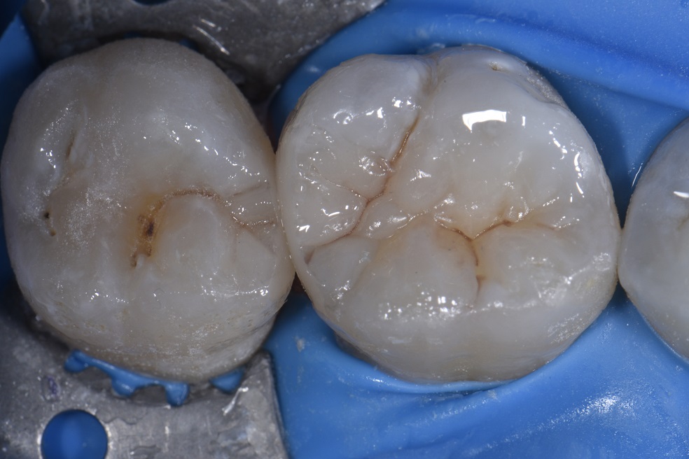 Closing Food Traps using Resin Restorations