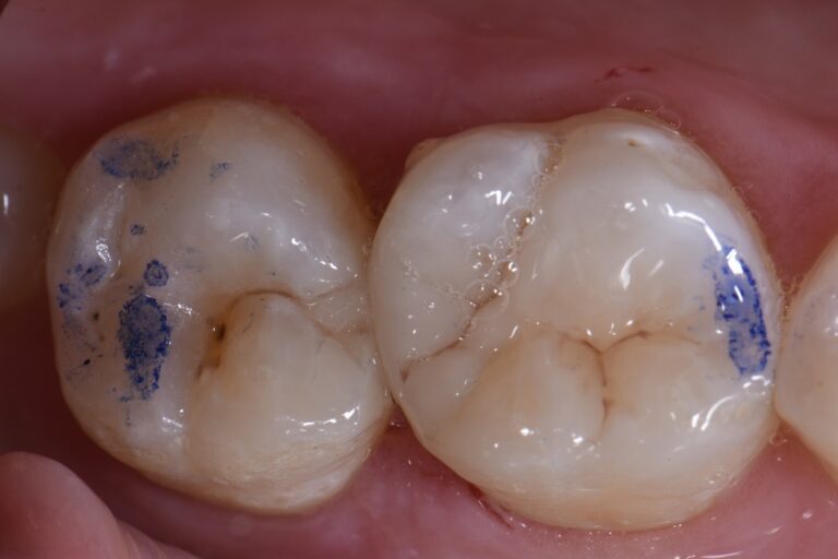 Closing Food Traps using Resin Restorations
