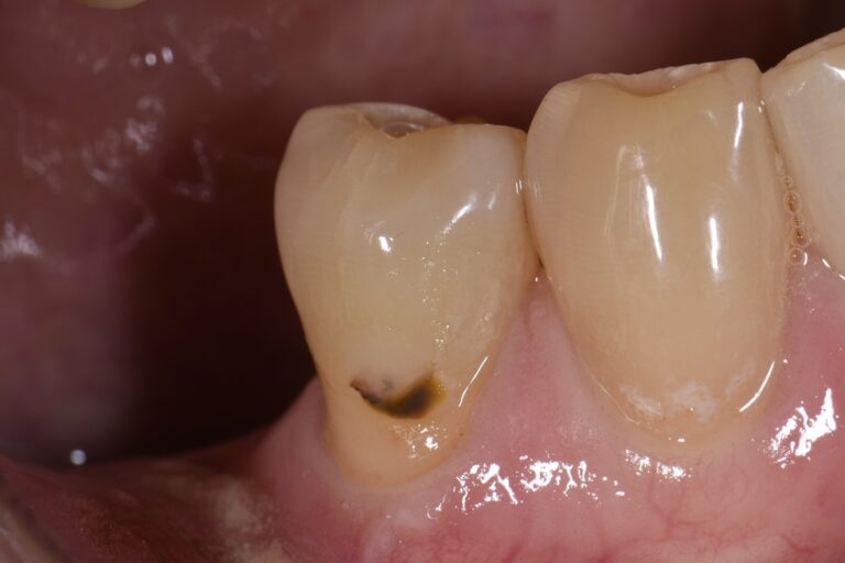 Cavities on the Root Surface