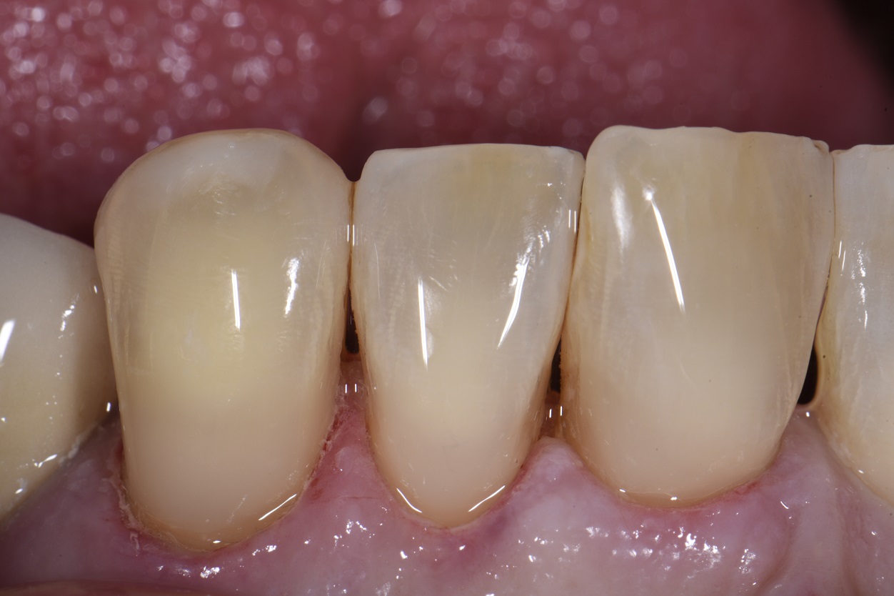 Minor additions to protect dentin on cervical abrasions