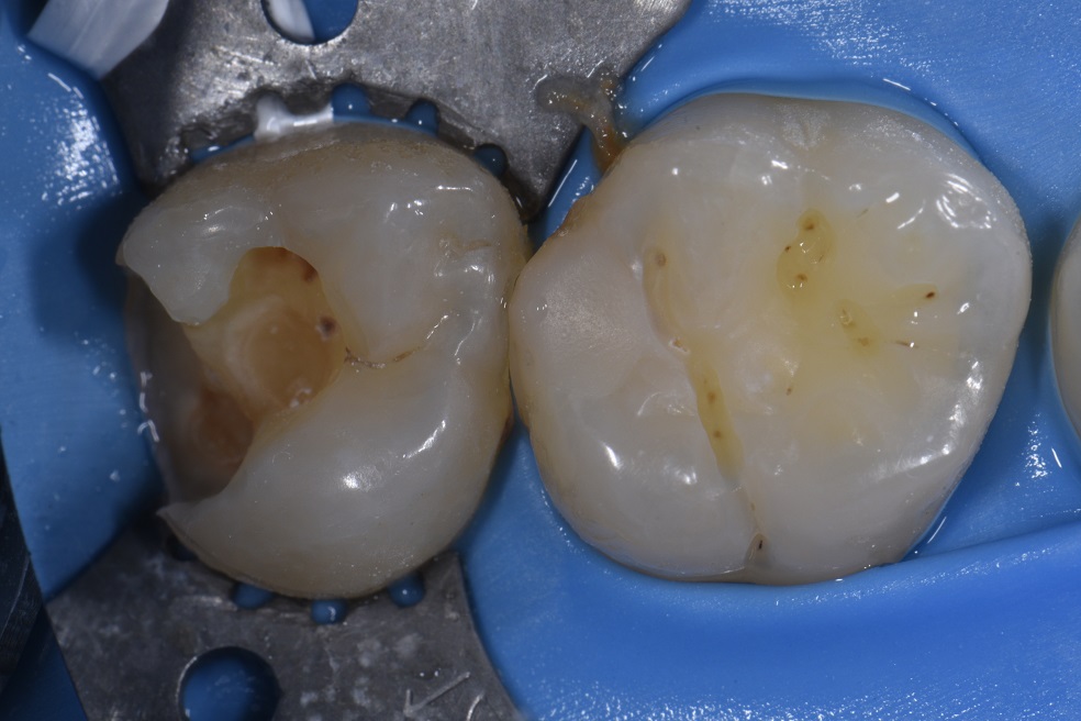 Replacing Old Leaking Fillings with Sculpted Composite Resin