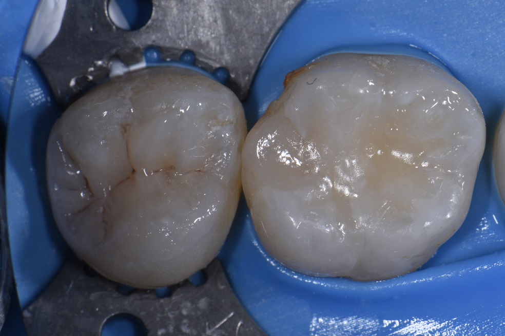 Replacing Old Leaking Fillings with Sculpted Composite Resin