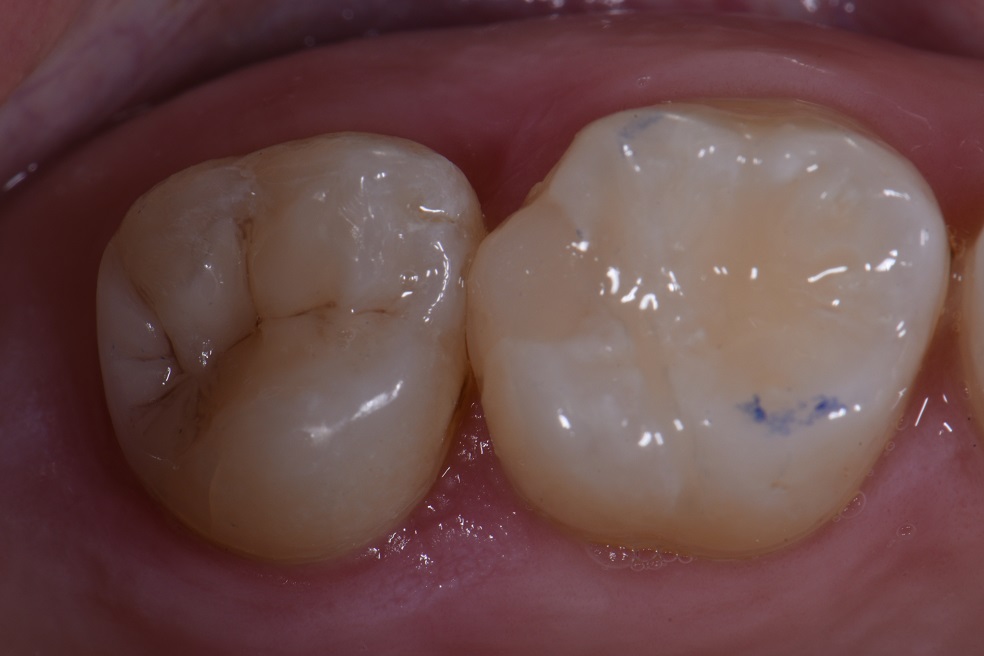Replacing Old Leaking Fillings with Sculpted Composite Resin