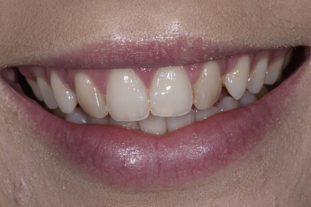 Composite Veneers to rival porcelain without the drilling