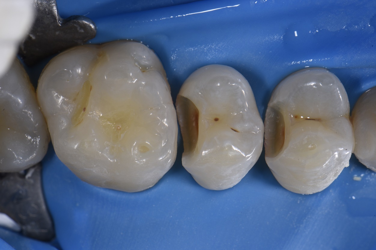 Quadrant Dentistry Invisible Composite Restorations Fillings