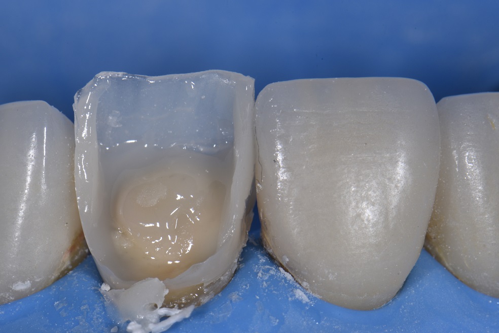 Freehand Composite Crown Fabrication to match Porcelain Veneers