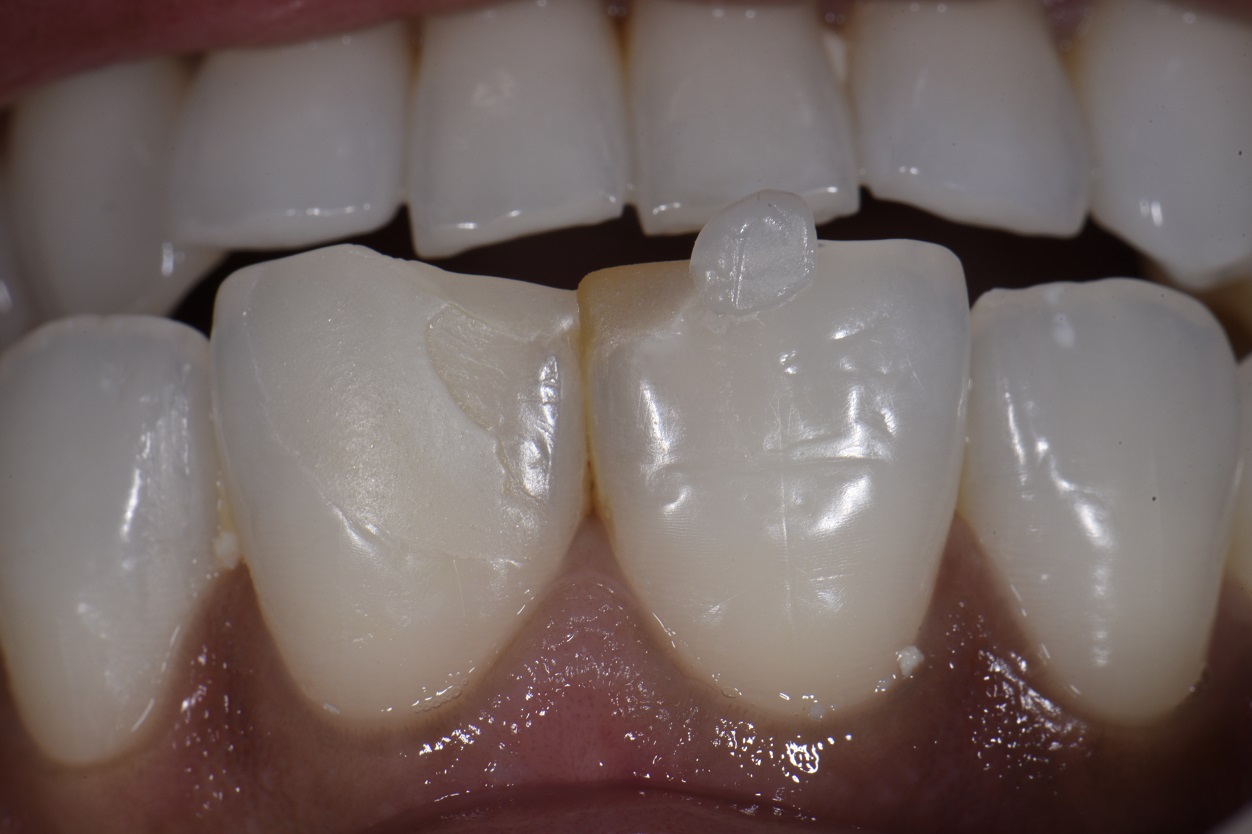 Class IV Fracture Replacement Restorations