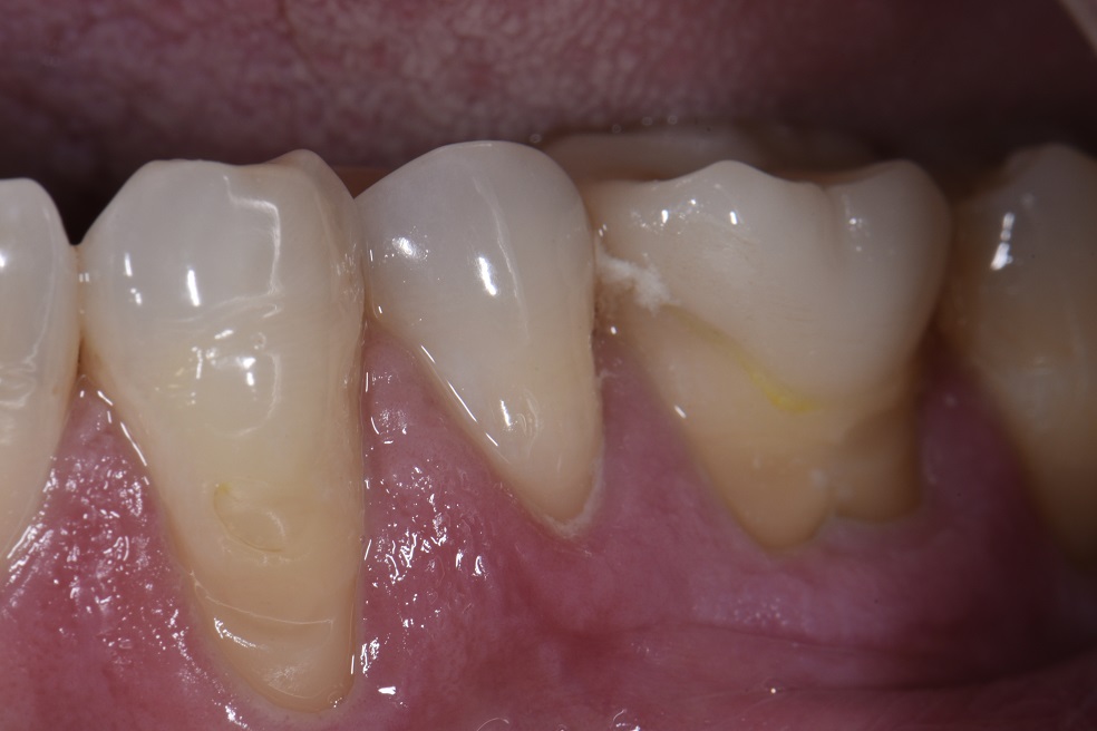 Treating Sensitive Teeth with Beautifully Skulpted Composite Resin