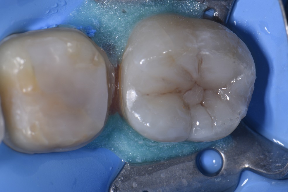 Removing Cracks and Supporting Residual Tooth Structure