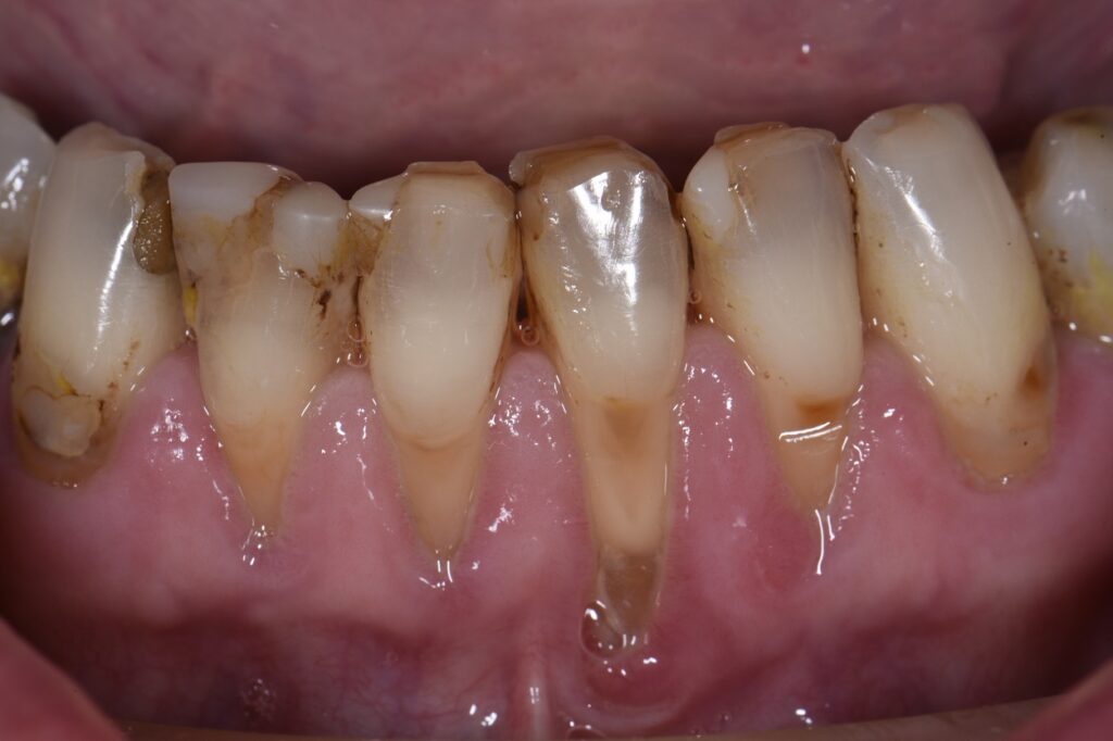 Extensive Class V restorations ahead of freehand direct coronal