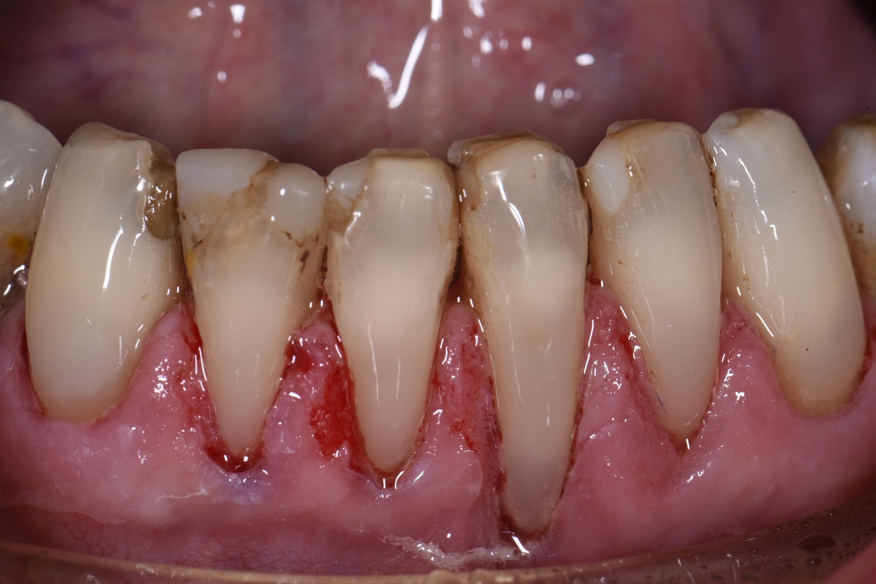 Extensive Class V restorations ahead of freehand direct coronal