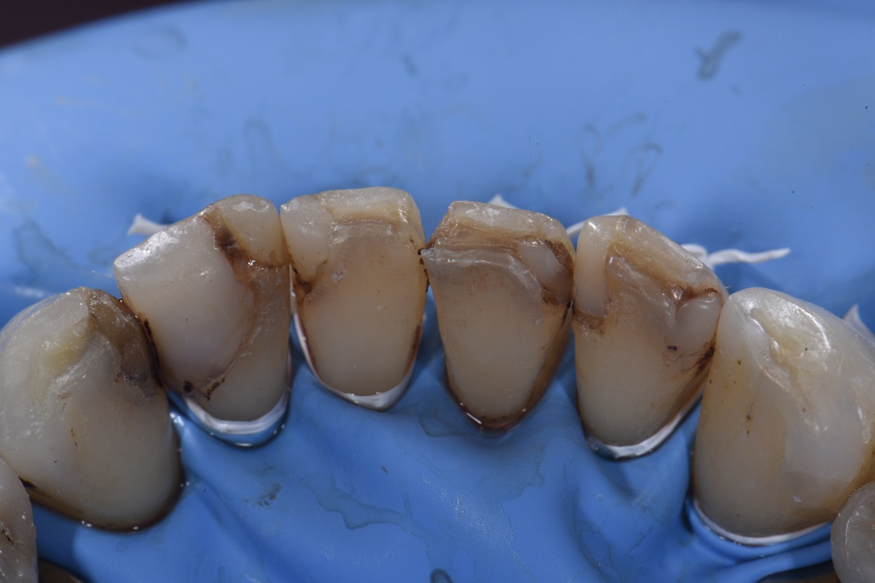 Extensive freehand reconstruction of broken down teeth