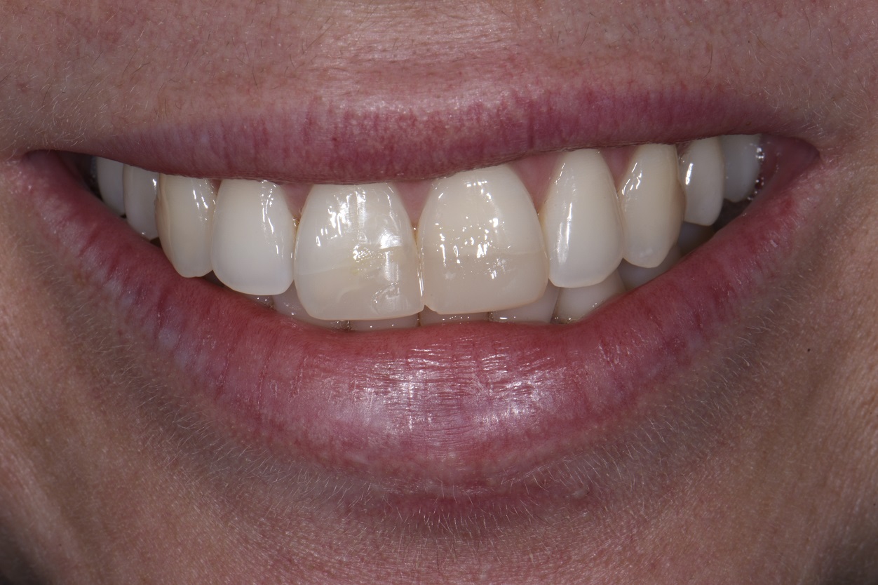 Composite Restorations that Mimic Nature