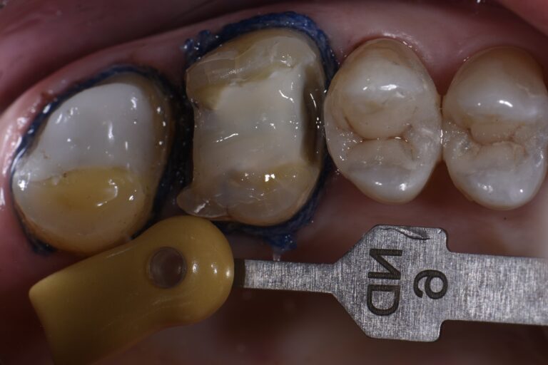 Quadrant Dentistry with Overlays and Composite