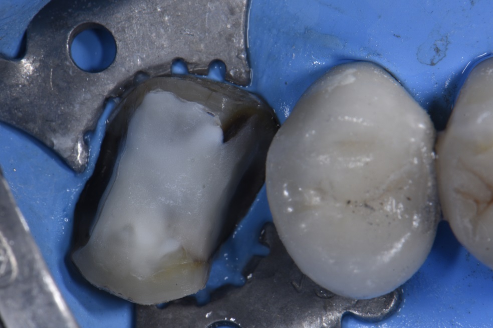 Extensively filled tooth supported with bonded overlay