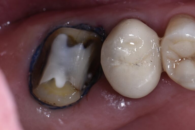 Extensively filled tooth supported with bonded overlay