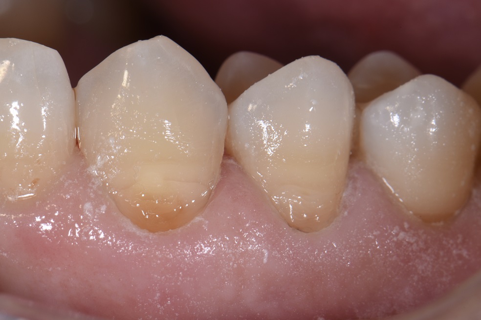 Class V seamless bonded restorations