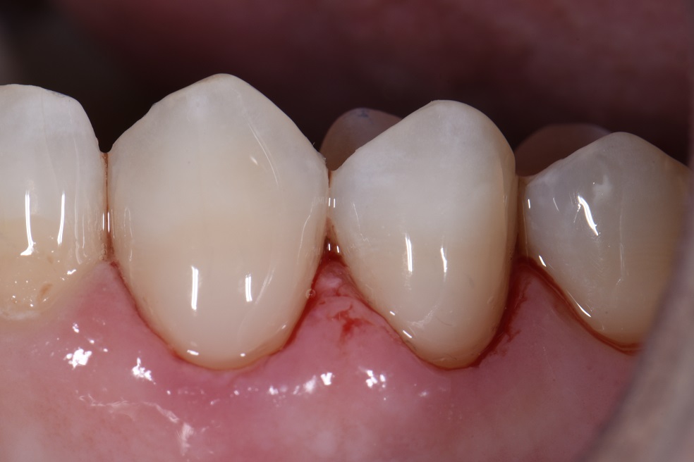 Class V seamless bonded restorations